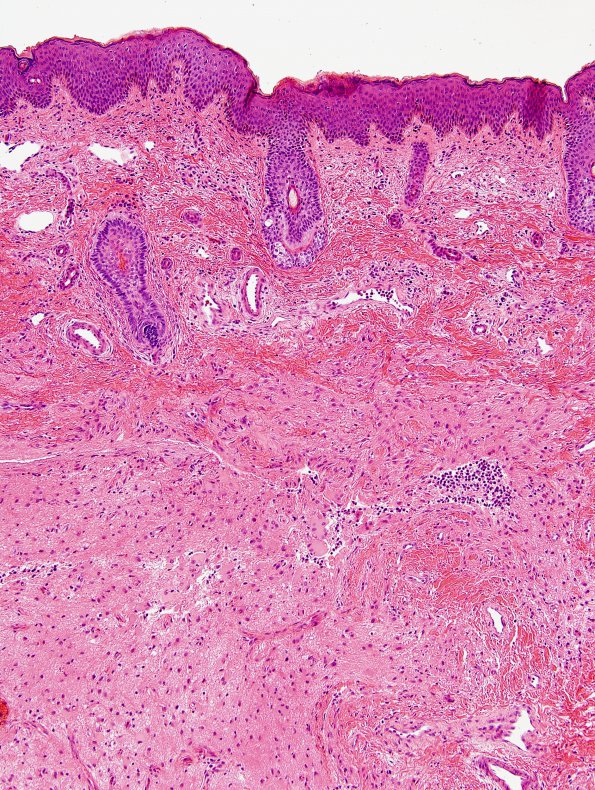 3C3 Encephalocele (no brain connection) Nasal Glioma (Case 3) H&E 1