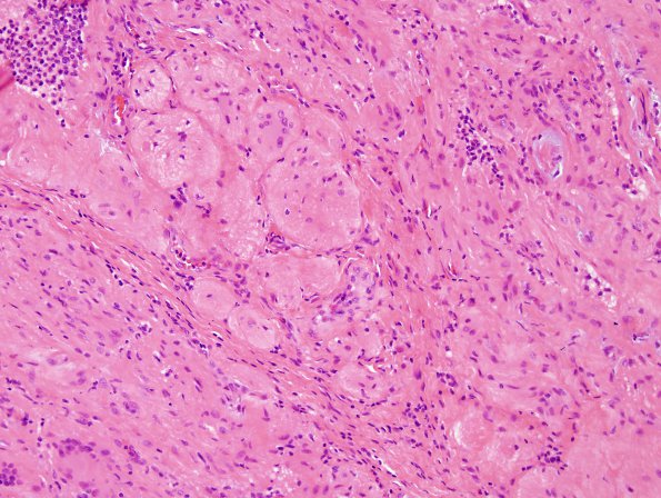 3C4 Encephalocele (no brain connection) Nasal Glioma (Case 3) H&E 4