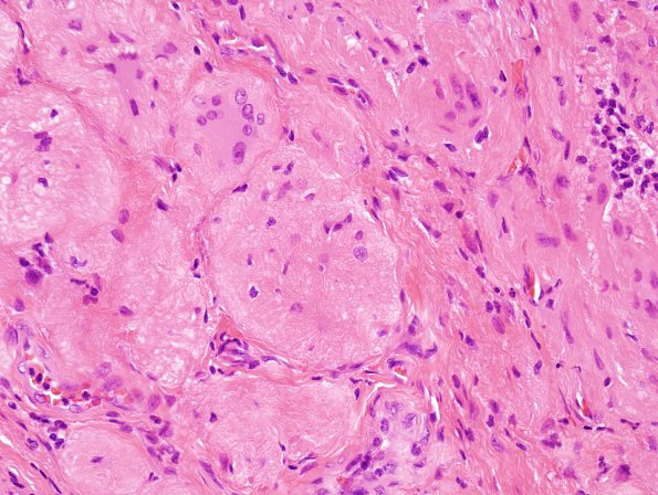 3C5 Encephalocele (no brain connection) Nasal Glioma (Case 3) H&E 5