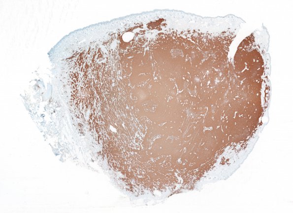 3D1 Encephalocele (no brain connection) Nasal Glioma (Case 3) GFAP whole mount