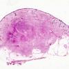 4A1 Encephalocele (Case 4) Nasal Glioma