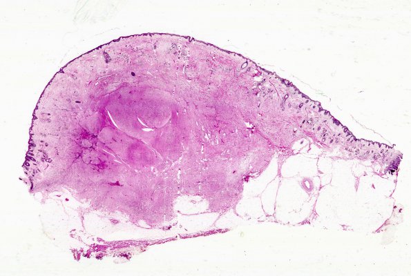 4A1 Encephalocele (Case 4) Nasal Glioma