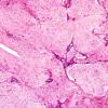 4A2 Encephalocele (Case 4) Nasal Glioma 10XA