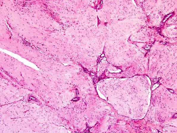 4A2 Encephalocele (Case 4) Nasal Glioma 10XA