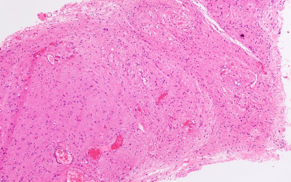 5A1 Heterotopia, sphenoid sinus (nasal glioma, encephalocele, Case 5) H&E 3