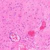 5A2 Heterotopia, sphenoid sinus (nasal glioma, encephalocele, Case 5) H&E 4