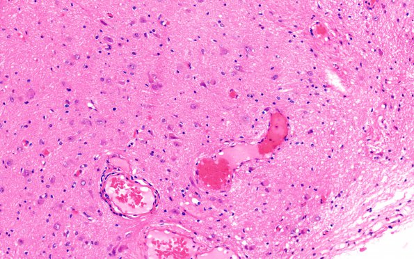 5A2 Heterotopia, sphenoid sinus (nasal glioma, encephalocele, Case 5) H&E 4