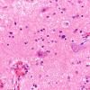 5A3 Heterotopia, sphenoid sinus (nasal glioma, encephalocele, Case 5) H&E 2 copy