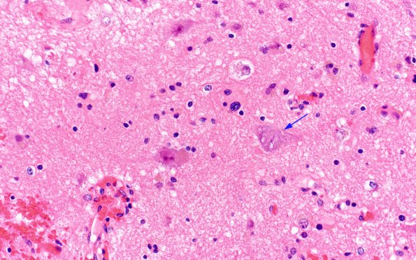 5A3 Heterotopia, sphenoid sinus (nasal glioma, encephalocele, Case 5) H&E 2 copy