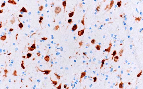 5B2 Heterotopia, sphenoid sinus (nasal glioma, encephalocele, Case 5) NeuN 1