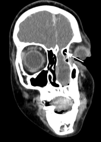 6A1 CT (Case 6) 5 copy