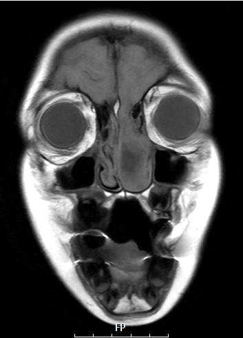 6A3 T1 THIN NoC (Case 6)