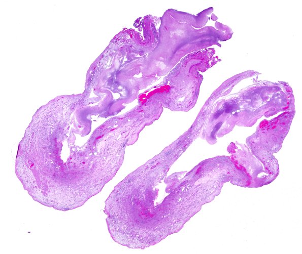 6B1Nasal glioma (Case 6) A3 H&E WM