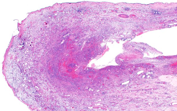 6B2 Nasal glioma (Case 6) H&E 2X
