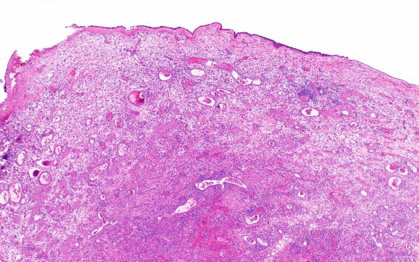 6B3Nasal glioma (Case 6) H&E 4X 2