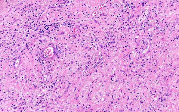6B4Nasal glioma (Case 6) H&E 20X 2