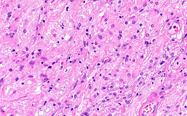 6B5Nasal glioma (Case 6) H&E 40X 2