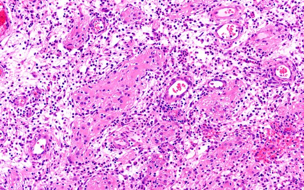 6B6 Nasal glioma (Case 6) H&E 20X