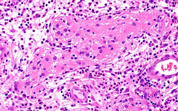 6B7 Nasal glioma (Case 6) H&E 40X
