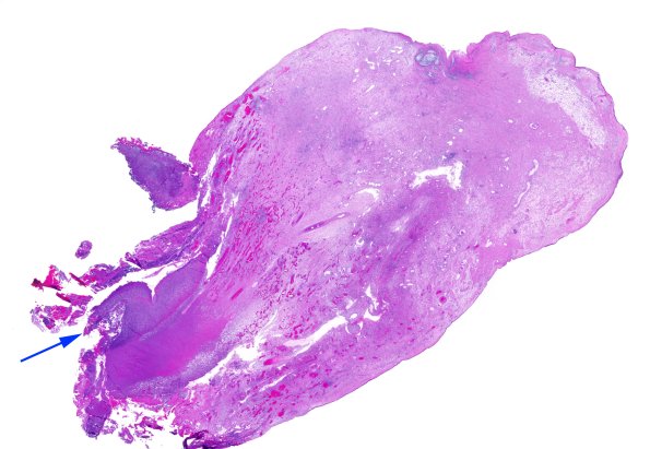 6C1Nasal Glioma (Case 6) A1 H&E WM copy
