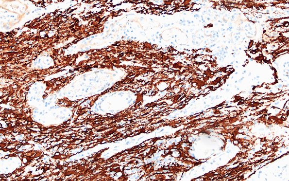 6C3Nasal glioma (Case 6) A1 GFAP 20X
