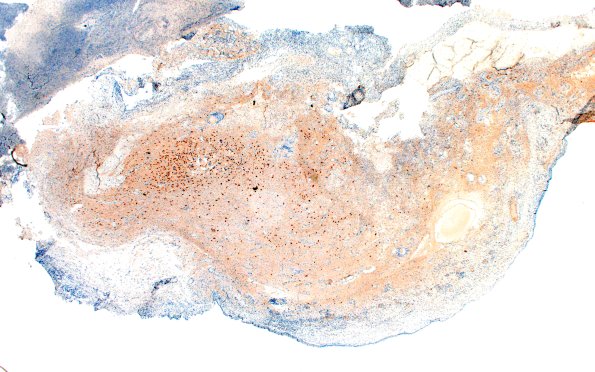 6D1Nasal glioma (Case 6) A2 Neu-N 2X