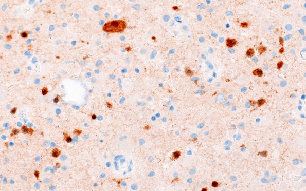 6D2 Nasal glioma (Case 6) A2 Neu-N 40X