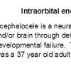 0A Encephalocele - Orbital