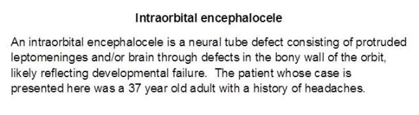 0A Encephalocele - Orbital