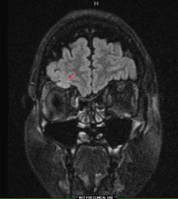 1A1 Encephalocele, intraorbital (Case 1) FLAIR 2