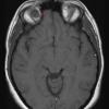 1A2 Encephalocele, intraorbital (Case 1) T1 1