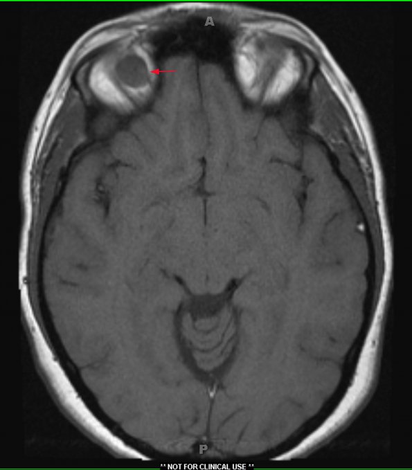 1A2 Encephalocele, intraorbital (Case 1) T1 1