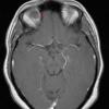 1A3 Encephalocele, intraorbital (Case 1) T1 W 1