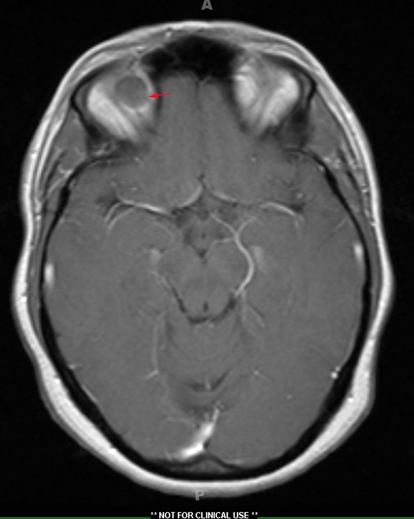 1A3 Encephalocele, intraorbital (Case 1) T1 W 1