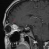 1A4 Encephalocele, intraorbital (Case 1) T1 W 2