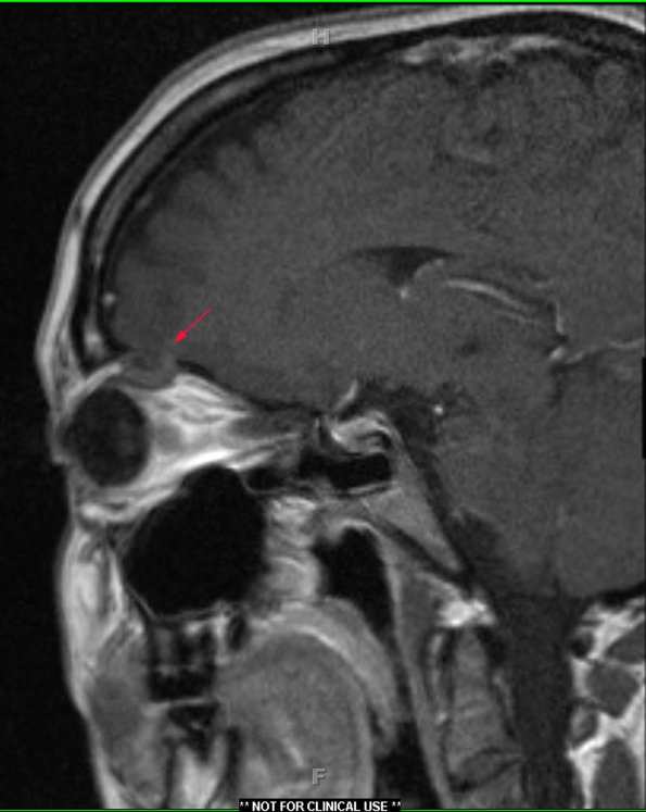 1A4 Encephalocele, intraorbital (Case 1) T1 W 2