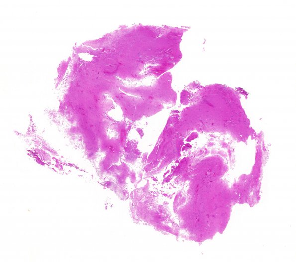 1B1 Encephalocele, intraorbital (Case 1) H&E whole mountA