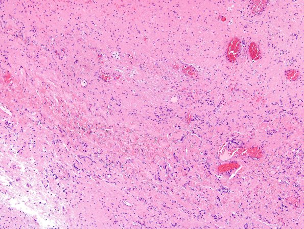 1B2 Encephalocele, intraorbital (Case 1) H&E 1A