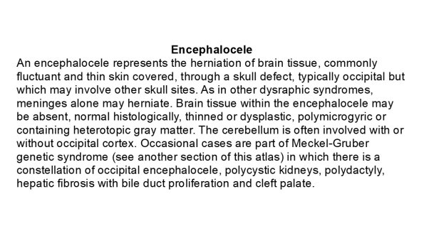 0A Encephalocele - Text