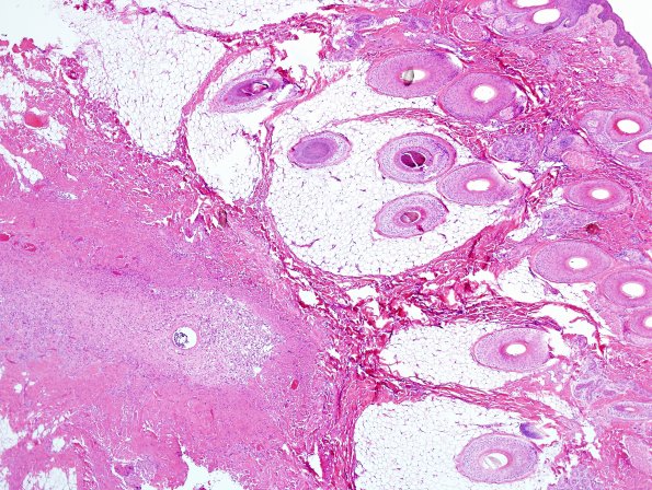 11A1-Encephalocele-Case-11-H-E-3.jpg