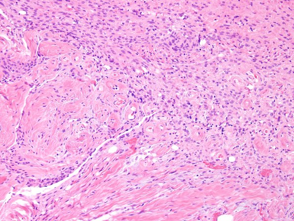 11A2-Encephalocele-Case-11-H-E-2.jpg