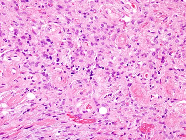 11A3-Encephalocele-Case-11-H-E-1.jpg