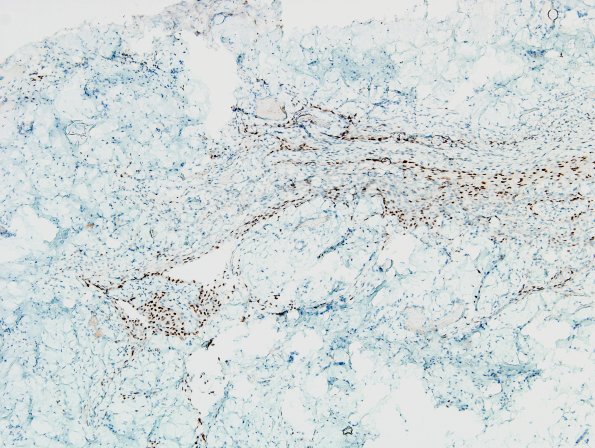 11B-Encephalocele-Case-11-PR-3.jpg