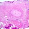 12A1-Encephalocele-Case-12-2.jpg