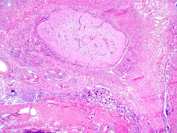 12A2-Encephalocele-Case-12-3.jpg