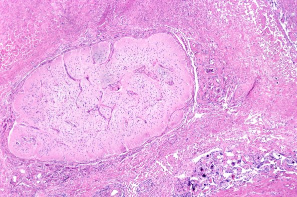 12A3 Encephalocoele (Case 12)