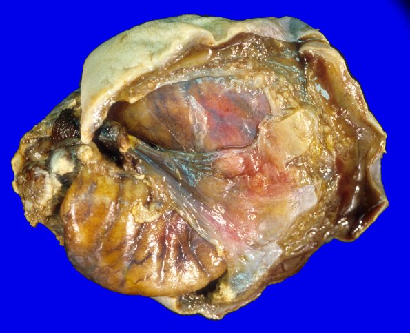 13A2-Encephalocele-Case-13-5