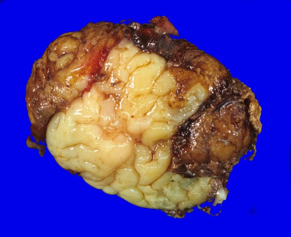 13A3-Encephalocoele-Case-13-3