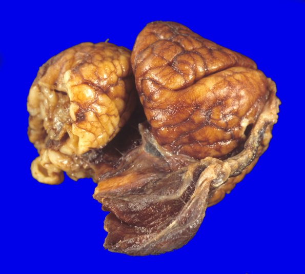 14A1 Encephalocoele (Case 14) 3