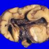 14A2 Encephalocoele (Case 14) 2